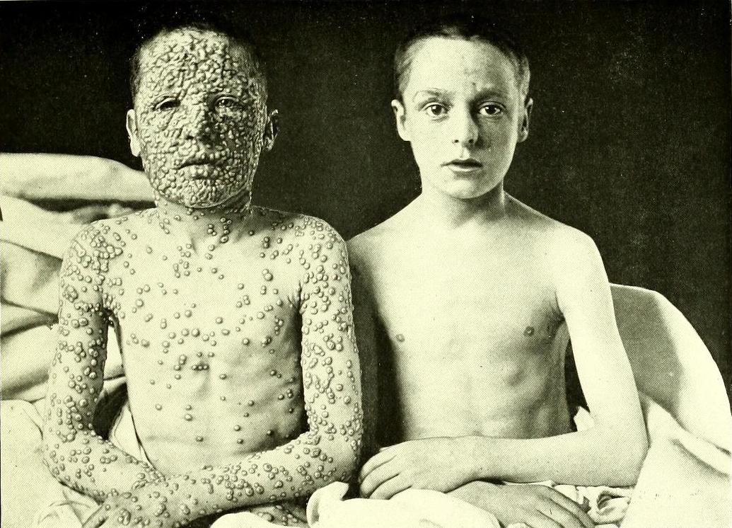 Photograph by Allan Warner of two boys who came in contact with smallpox, 1901. The one on the right was vaccinated in infancy, the other was not vaccinated.